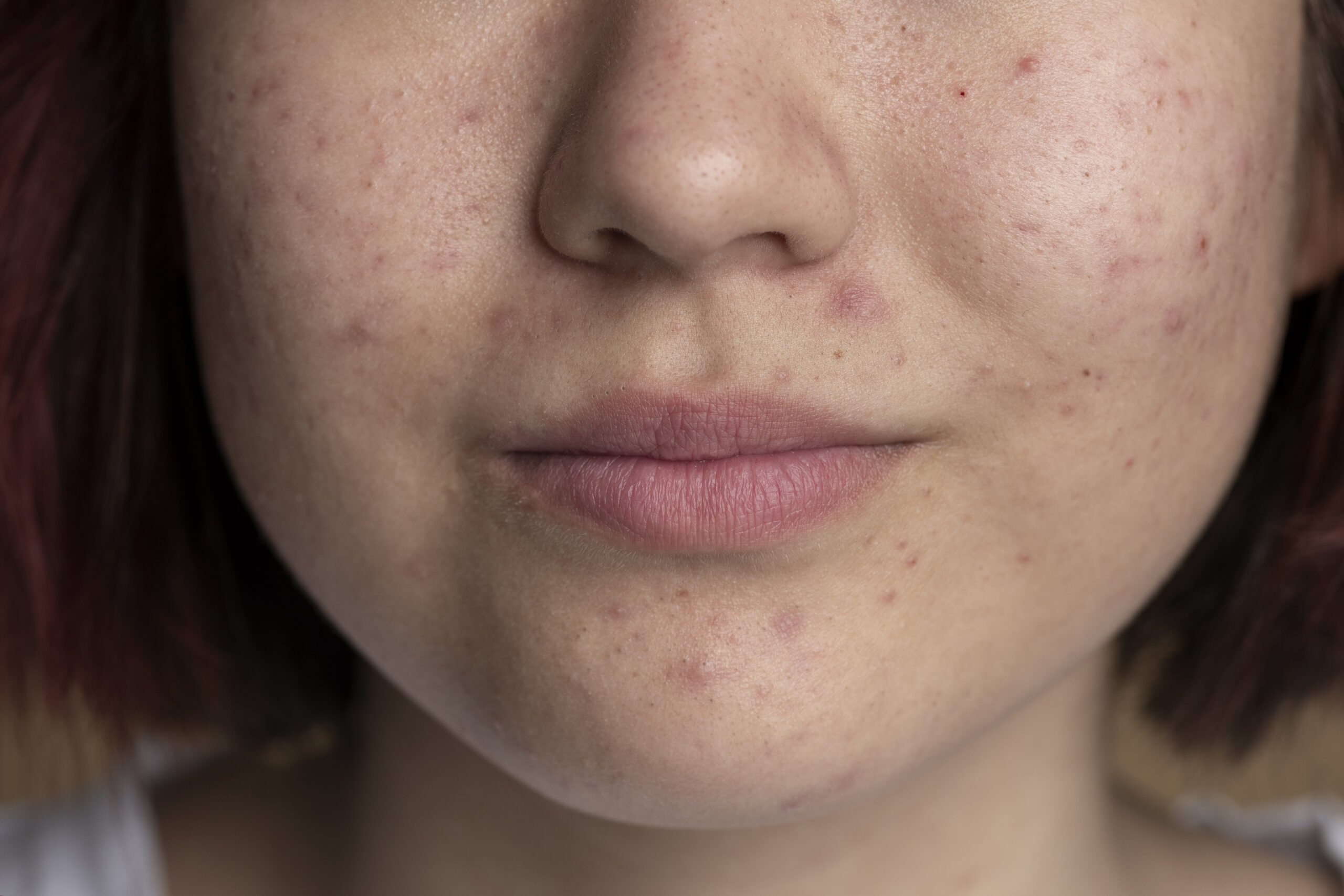 ACNÉ EN ADOLESCENTES: SOLUCIONES Y TRATAMIENTO